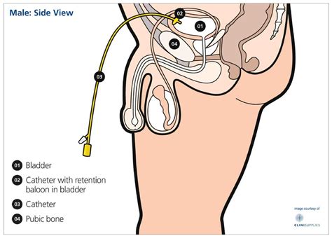 You and your catheter — Urology Associates