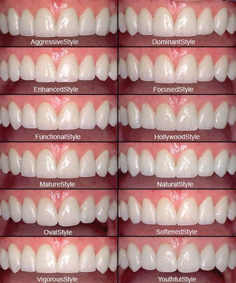 Pin by Smiles By Dr. Cook ~ Nicol R. on Esthetics | Dental cosmetics, Perfect teeth, Dental veneers