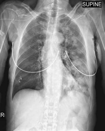 Acute aspiration pneumonitis | Radiology Reference Article ...