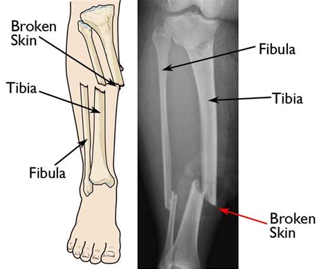 Open Fractures - OrthoInfo - AAOS