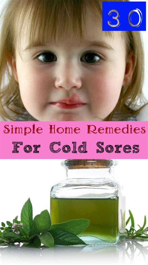 30 Simple Home remedies for cold sores... but home remedies can be ...