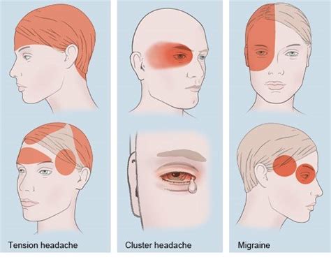 How do common types of headaches differ? | informedhealth.org