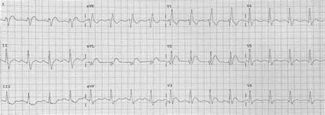 High Lateral STEMI • LITFL • ECG Library Diagnosis