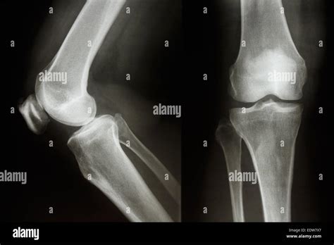 Normal Knee X Ray Lateral View