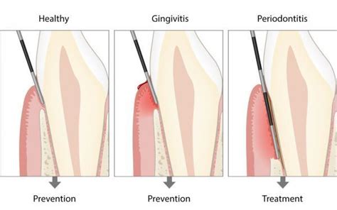 Diagnosing periodontitis - Read all info at periodontal-health.com