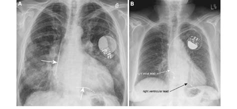 Implantable Cardioverter Defibrillator Vs Pacemaker