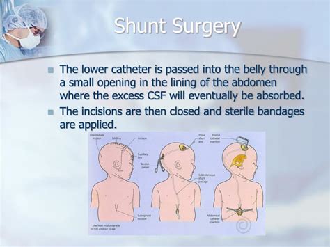 PPT - Hydrocephalus & Shunts PowerPoint Presentation - ID:431868