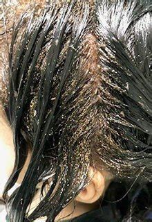 Will Head Lice Go Away Without Treatment? | LiceDoctors