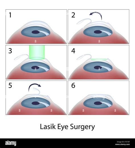 Lasik eye surgery procedure Stock Photo - Alamy