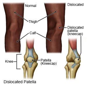 Patellar Dislocation (Aftercare Instructions)