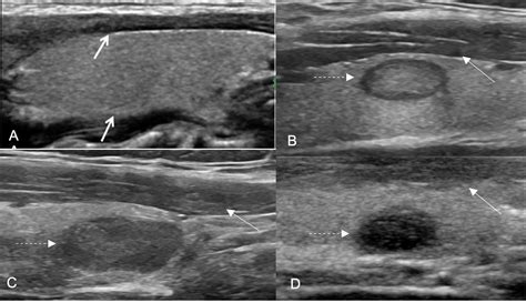 Does a three-degree hypoechogenicity grading improve ultrasound thyroid nodule risk ...