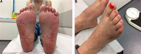 Keratoderma blennorrhagica | BMJ Case Reports