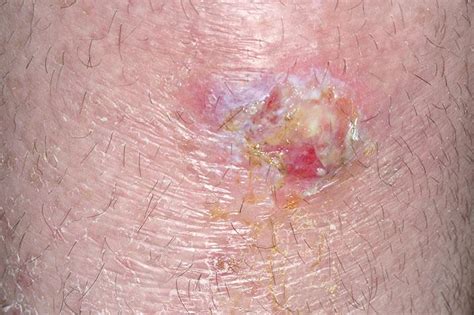 Pictures of Staph Infection on Skin | LoveToKnow