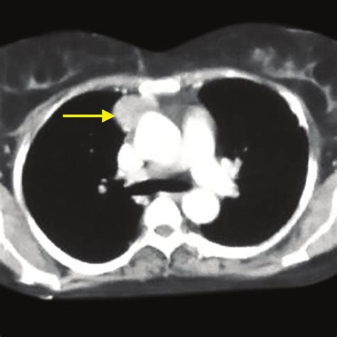 Anterior mediastinal mass (arrow) Fig. 2: Tumor arising from the body... | Download Scientific ...