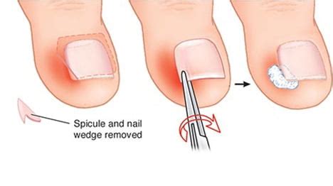 Ingrown Toenails Specialist · 2018 Top Foot Doctor, Podiatrist ·NYC