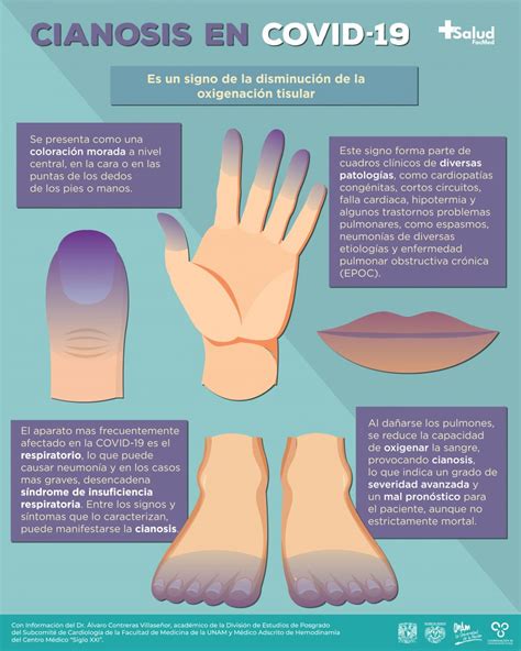 Cianosis en COVID-19 - +Salud FacMed