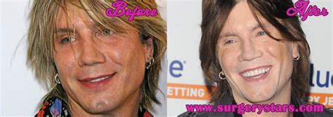 12+ John Rzeznik Plastic Surgery - NikolaiLabraun