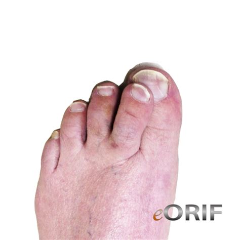 Crossover Toe Correction 28313 | eORIF