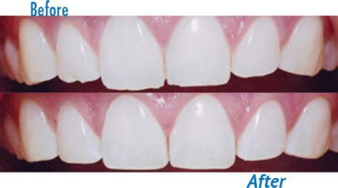 Different types of #dental contouring procedures: - Tooth contouring and reshaping. - #Dental ...