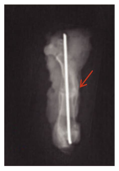 DR imaging evaluation result. Fracture healing assessed by DR imaging... | Download Scientific ...