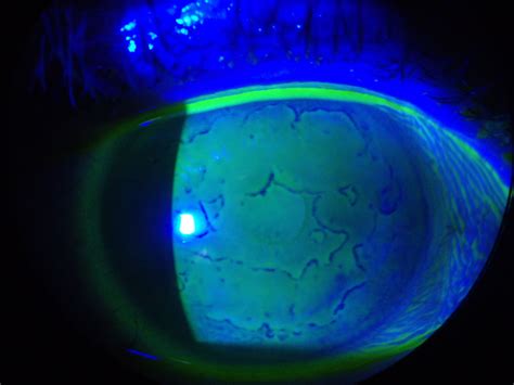 Map Dot Fingerprint Dystrophy Treatment - Maps Model Online