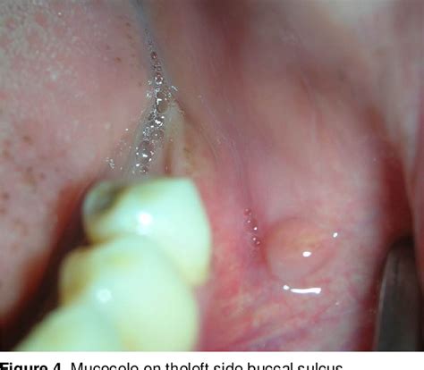 Figure 4 from Oral Mucocele - Diagnosis and Management | Semantic Scholar