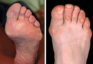 Corns & Callus | What Are They & How Can They Be Treated? | FootSmart ...