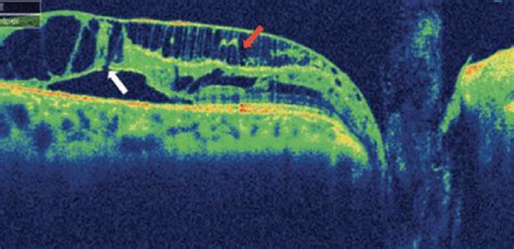 Peripapillary, Macular Retinoschisis Can Develop Without Visible Optic Pit, Advanced ...