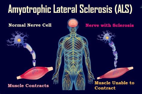 Amyotrophic Lateral Sclerosis (ALS) -Symptoms and Causes - How to ...