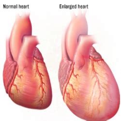 Enlarged Heart Causes, Symptoms, And Treatment – Natural Home Remedies ...