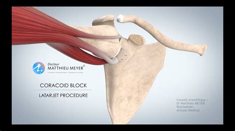 SHOULDER STABLISATION BY CORACOID BLOCK (LATARJET PROCEDURE) - DR MATTHIEU MEYER - PARIS, FRANCE ...