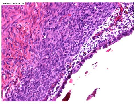 Ovarian Cyst Histology