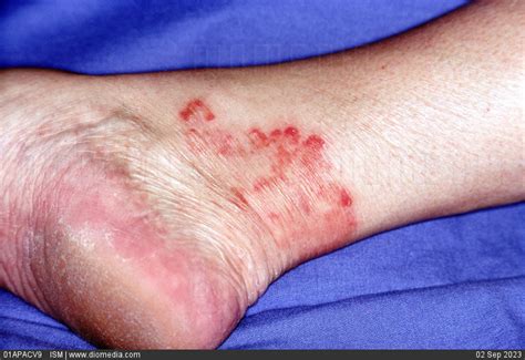 STOCK IMAGE, dermatophytosis on the ankle a type of dermatomycosis ...