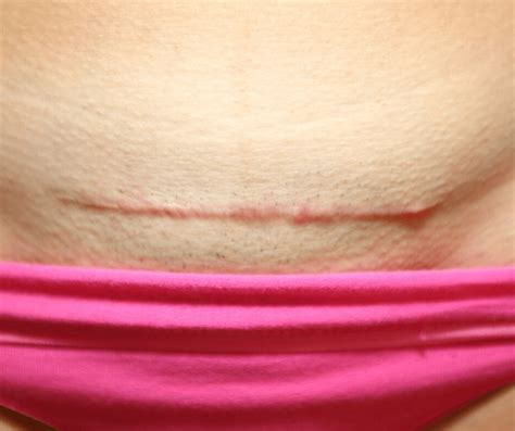 What You Should Know About Your Cesarean Scar