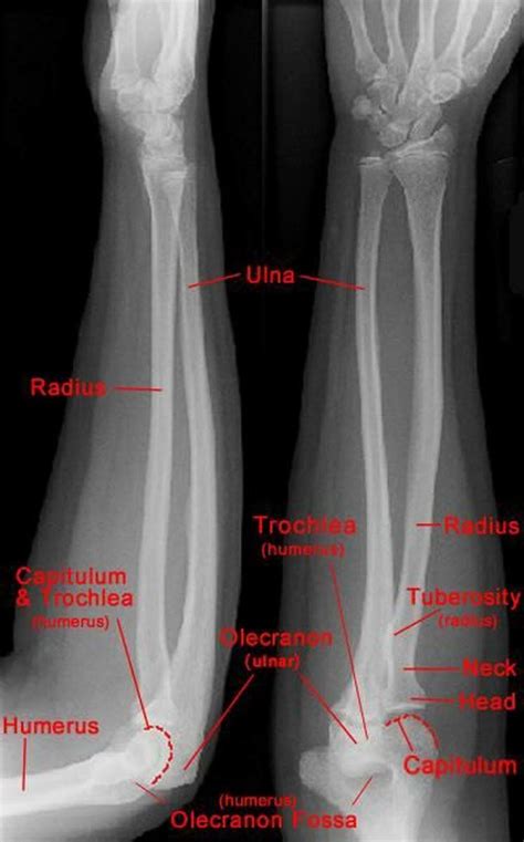 Forearm Radiograph | Medical radiography, Radiology student, Medical anatomy