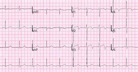 Dr. Smith's ECG Blog: Wellens' waves are NOT equivalent to Wellens' syndrome: Pseudo-Wellens ...