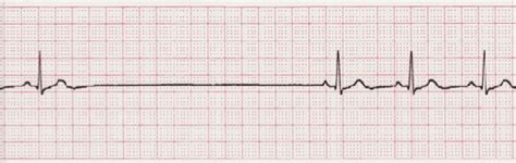 Sinus Arrest - EKG Lesson #313