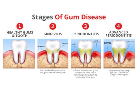 Fantastic Info About How To Keep Gums Healthy - Policebaby25