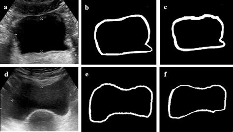 a) cystitis ultrasound image; b)Ground truth image; c) bladder wall ...