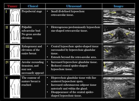 Tanner scale of puberty | Radiology imaging, Medical ultrasound, Breast ...