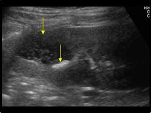 Urinary Tract and male reproductive system | 2.1 Kidney and ureter : Case 2.1.3 Renal cysts ...