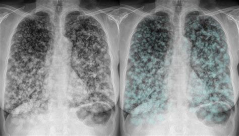 How To Evaluate Diagnose And Treat Small Lung Nodules - vrogue.co