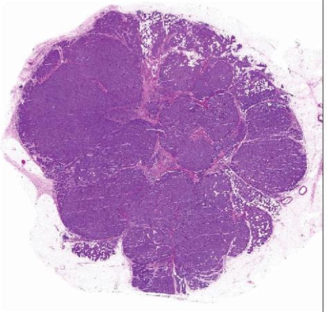 Invasive Lobular Carcinoma Image