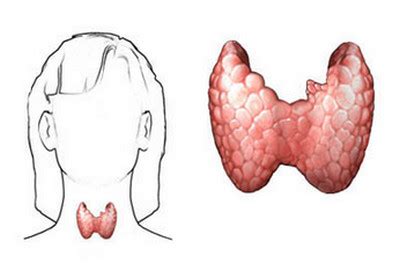 Cretinism - Symptoms, Causes, Pictures and Treatment