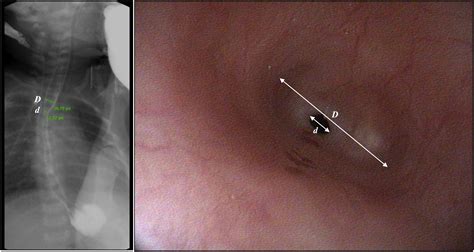 Anastomotic Stricture Definition After Esophageal Atresia Repair: Role of Endoscopic Stricture ...