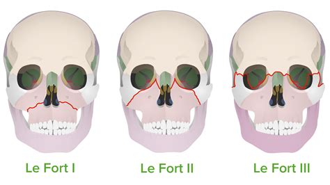 Le Fort Iii Fracture