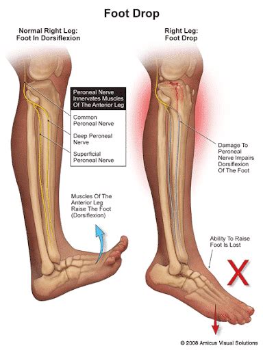 Superficial Peroneal Nerve Dermatome