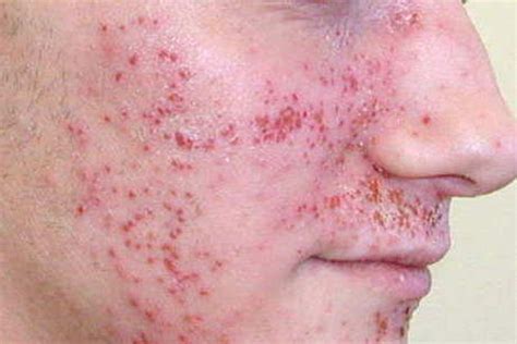 Vesicular Skin Rash