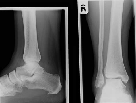 Tibia And Fibula X Ray