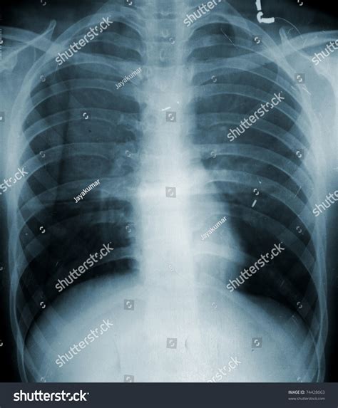 X-Ray Image Of Human Chest Stock Photo 74428063 : Shutterstock